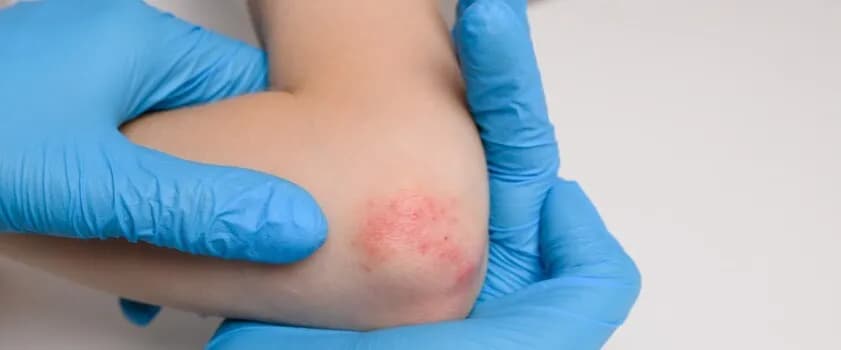 Alergia na sierść objawy skórne – jak je rozpoznać i leczyć